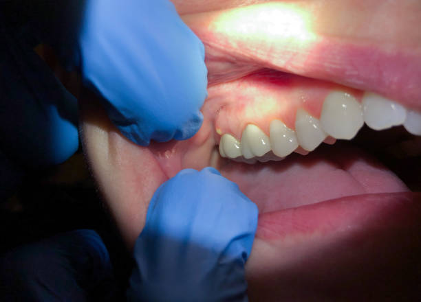 Best Emergency Tooth Extraction in Mount Jackson, VA